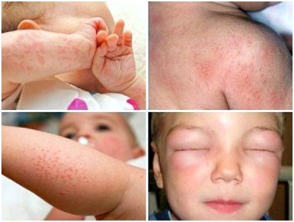 Признаки аллергии у ребенка